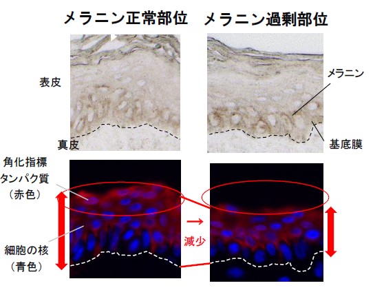 ▲図1 メラニン正常部位とメラニン過剰部位の角化指標タンパク質(赤色）の分布と細胞核（青色）の並びを比較