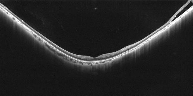 画像イメージ（眼底のOCT断層画像）