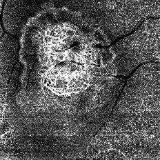 中心窩下脈絡膜新生血管（CNV：choroidal neovascularization ）