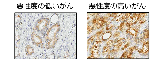 図2　手術検体のLAT３の免疫染色。 悪性度の高いがんでLAT３がより茶色く染まり、多く発現していることを示している。