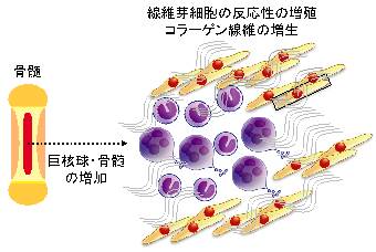 骨髄線維症の病態