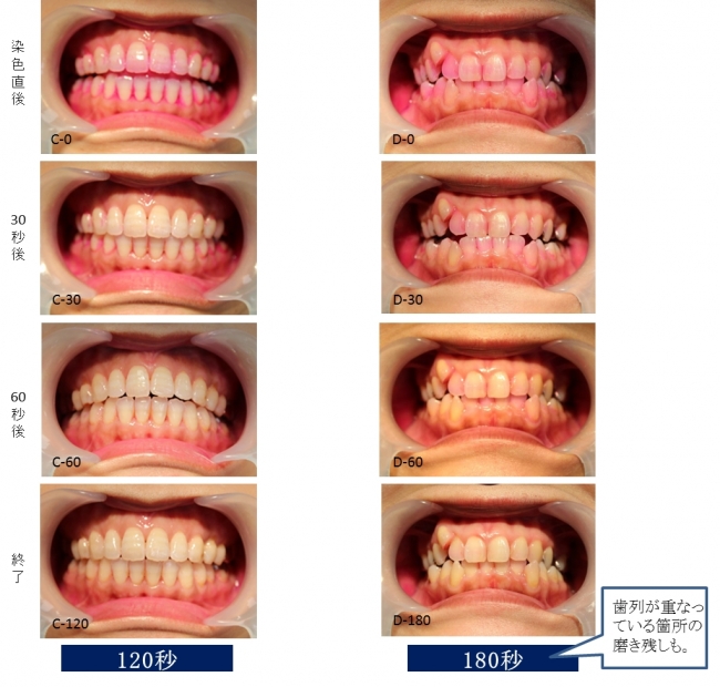 （左）歯並びの良いCさん　（右）歯並びの悪いDさん