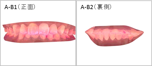 ▲歯並びの良いAさん（染色直後）