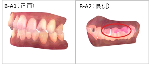 ▲歯並びの悪いBさん（60秒後）