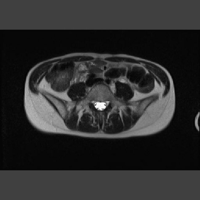 モニターMRI