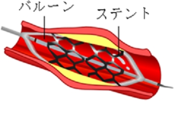 ステントの使用イメージ