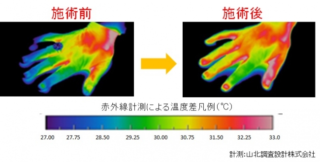 施術前後で、冷えやすい手の先等の体温上昇が確認されました。