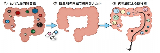 抗生剤併用便移植療法