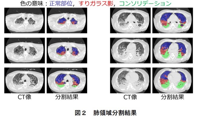 図２　肺領域分割結果