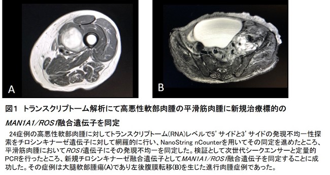 図１　トランスクリプトーム解析にて高悪性軟部肉腫の平滑筋肉腫に新規治療標的のMAN1A1／ROS1融合遺伝子を同定