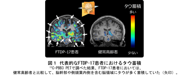 図１ 代表的なFTDP-17患者におけるタウ蓄積