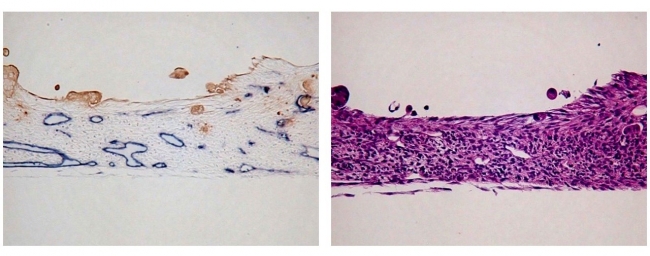 3D細胞培養技術により作製した人工組織の標本切片　左図（切片の免疫染色結果）：組織内に血管管腔が形成（がん部は茶色、微小血管は青色)　右図（切片のHE染色結果）：細胞が立体的に積層　(細胞核は紫色)