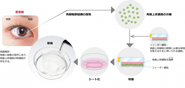 図：自家培養角膜上皮「ネピック」の移植