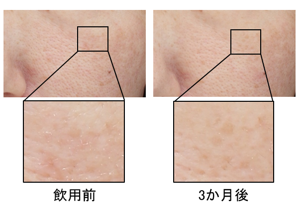 カサつき改善の代表例（40代女性・頬部）