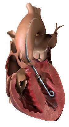 左室に挿入・留置されたIMPELLA 2.5®