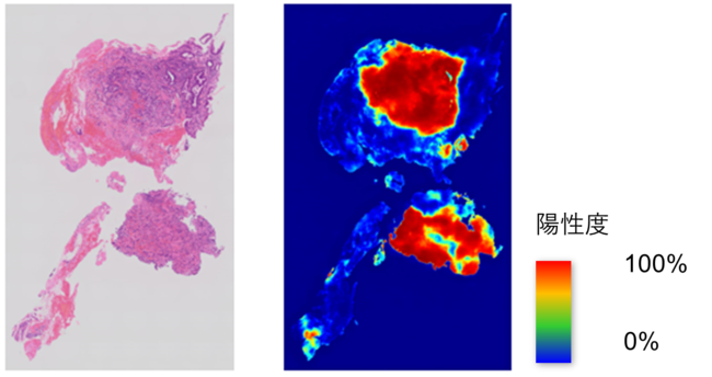 AI病理診断支援ソフトウェアの推論結果イメージ　左：元の病理ホールスライド画像　右：AI病理診断支援ソフトウェアが推論したヒートマップ　腺がんの確率が高く、陽性と思われる部位は赤く表示し、腺がんの確率が低い、陰性と思われる部位は青く表示。