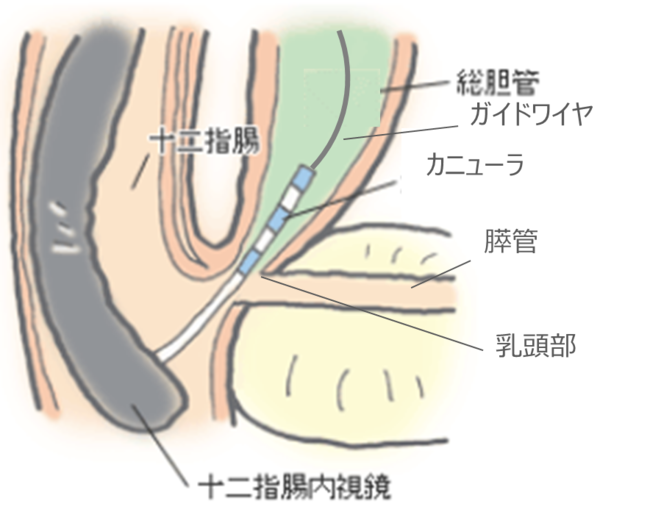 内視鏡を通じて胆管に挿入したカニューラから、ガイドワイヤを挿入する様子（イメージ）