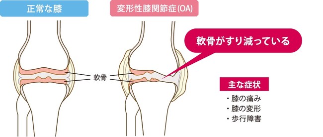 図2：変形性膝関節症（OA）の症状イメージ