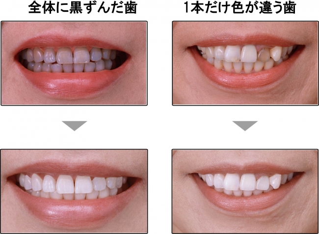 歯のマニキュア塗布Before After