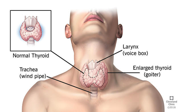 Thyroid Cancer Diagnosis