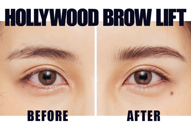 HOLLYWOOD BROW LIFT before after