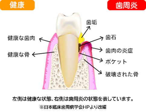 歯周病とは